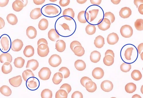 Blood smear with schistocytes. Take our hypertension emergency quiz. Source: Wikipedia