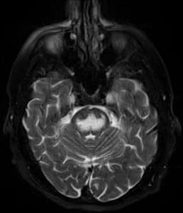 MRI of the Brain reveals central pontine myelinolysis.