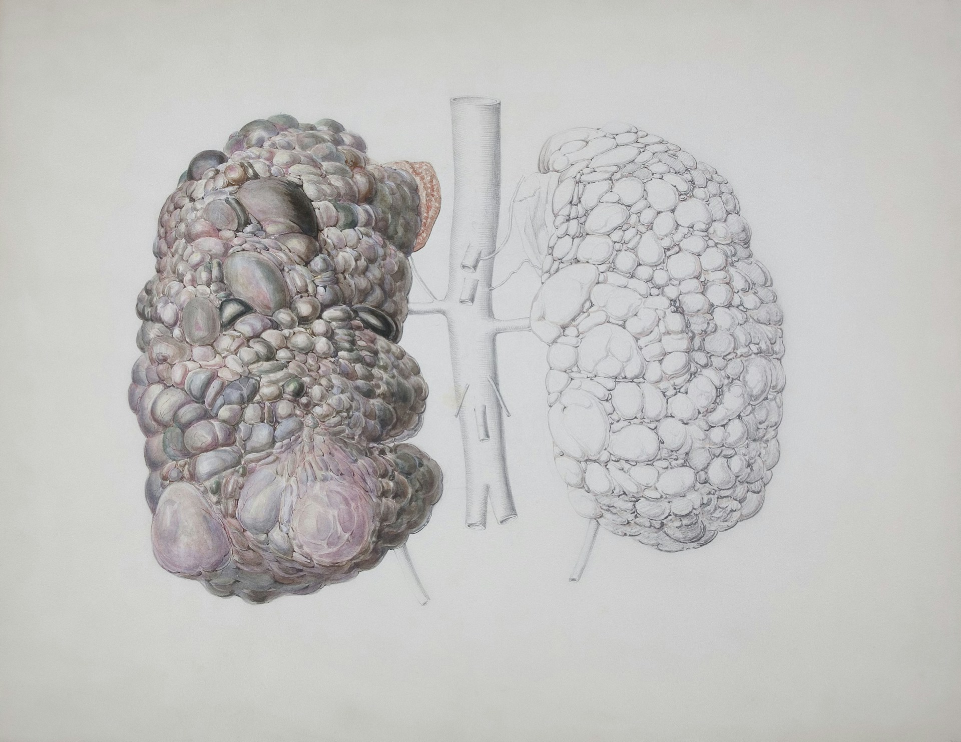 Polycystic kidneys