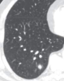 A kidney transplant patient with fevers 5 months post-transplant underwent a lung CT scan. What is the diagnosis?