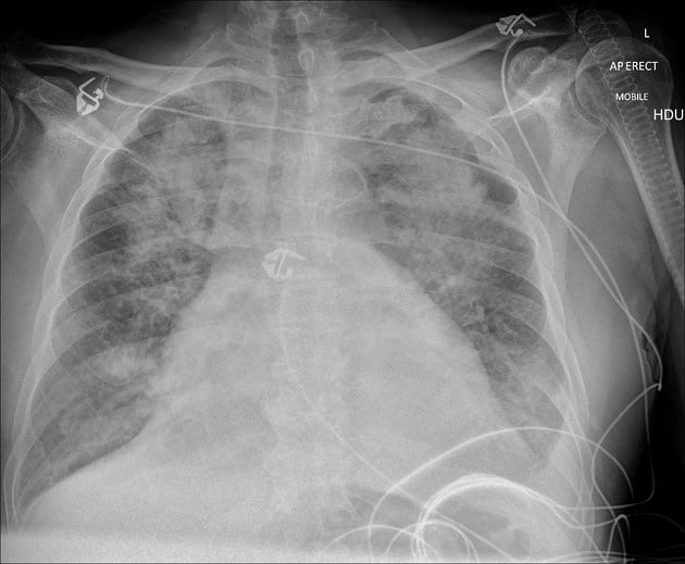 pulmonary edema on