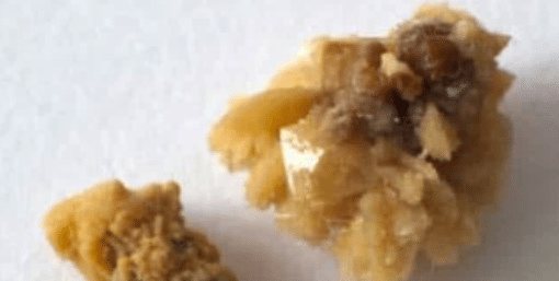 quiz what type of kidney stones are these