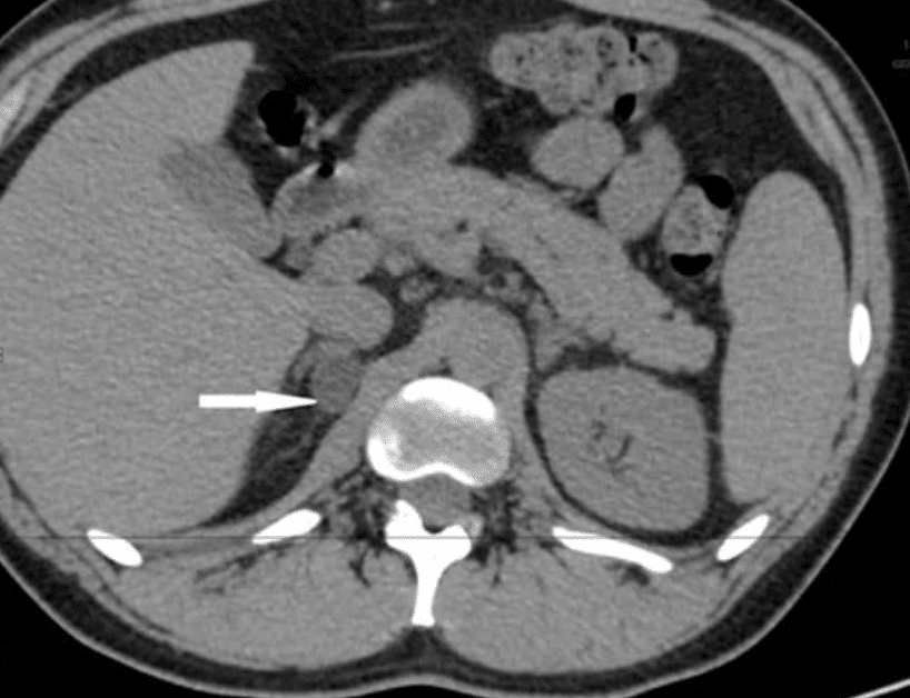 right adrenal adenoma quiz