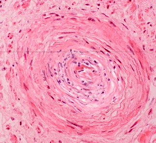 Patient with thrombotic microangiopathy post bone marrow transplant. Kidney Biospy shows onion skinning. Quiz.