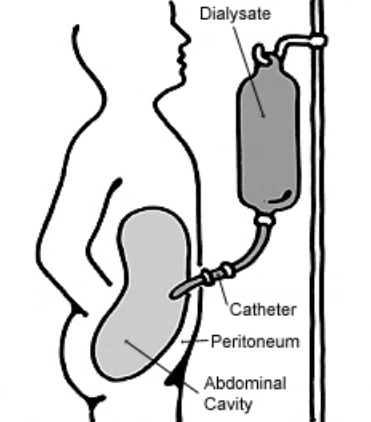 The patient is receiving peritoneal dialysis. She needs an assessment for cad in ESRD.