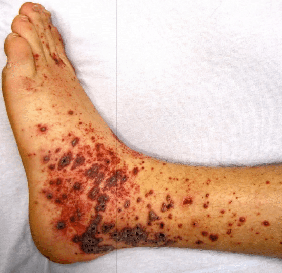 Patient with a rash on the legs and acute kidney injury