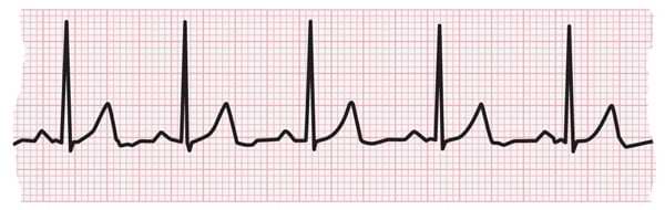 EKG rhythm strip. Assessing cad in ESRD, transplant quiz