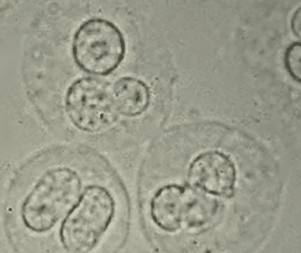 White blood cells in the urine suggesting acute interstitial nephritis.